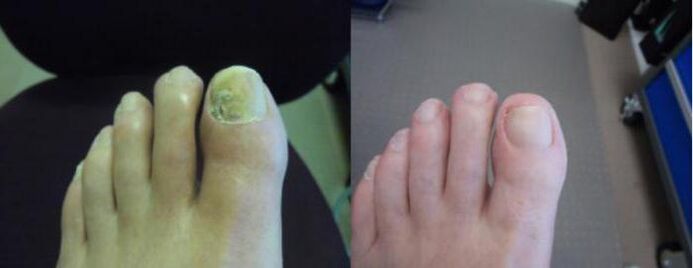 Zenidol krem ​​kullanmadan önce ve sonra ayak fotoğrafları