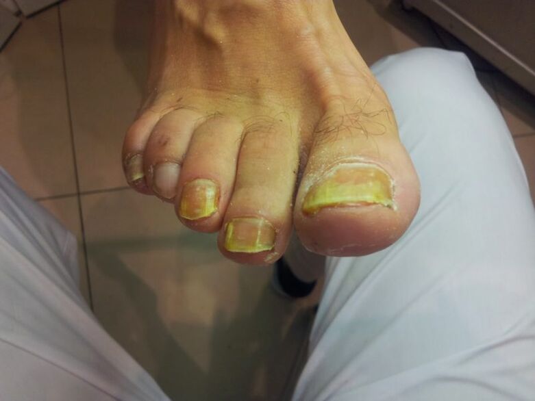 mantarlı sarı ayak tırnakları