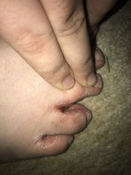 ayak mantarı enfeksiyonu
