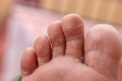 ayak parmaklarının mantar enfeksiyonlarının belirtileri