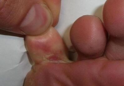 ayak parmağında bir çatlak mantar enfeksiyonunun sonucudur